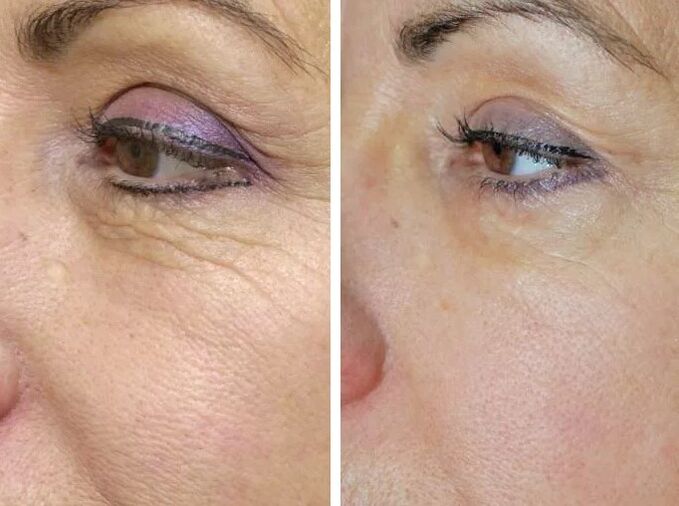 Campo laser prima e dopo